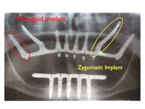 Have you been told that you just don’t have enough bone on your upper arch that can support implant teeth? Have you been advised that in order to have implants placed on your upper arch that a bone graft and or a sinus lift would need to be the first step towards placing implants?