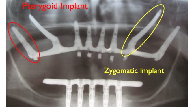 Pterygoid, NASAL ve Zigomatik implantlar