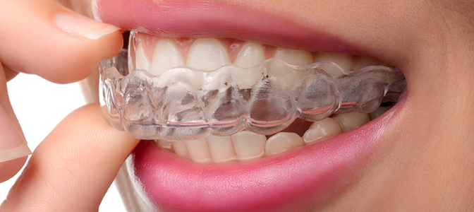 Dişlerin, tel tedavisi görmeden düzeltilebilmesi için uygulanan bir tedavi yöntemidir.