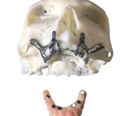Dijital olarak yapılan Subperiostal İmplantlar ile normal implant yapılamayacak üst çene dişsiz hastaları dişlerine kavuşturma
