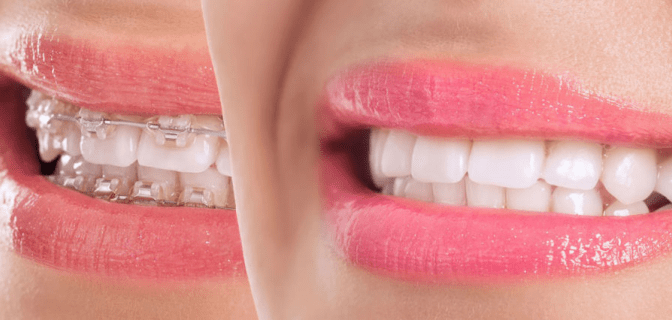Diş teli tedavi süreçlerinde bireyler içinde bulundukları zaman dilimlerinde hızlı sonuç almak için uğraşmaktadırlar. Ancak bazı bireyler uzun süreli tedaviler arasında bu tedavi sürecini de görerek süreçten kaçınmaya çalışmaktadır. Diş tellerim erken çıkabilir mi? sorusunu sizler için ele alalım: