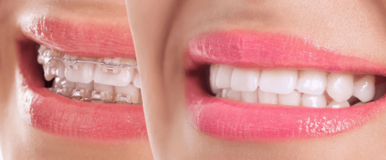 Diş teli tedavi süreçlerinde bireyler içinde bulundukları zaman dilimlerinde hızlı sonuç almak için uğraşmaktadırlar. Ancak bazı bireyler uzun süreli tedaviler arasında bu tedavi sürecini de görerek süreçten kaçınmaya çalışmaktadır. Diş tellerim erken çıkabilir mi? sorusunu sizler için ele alalım: